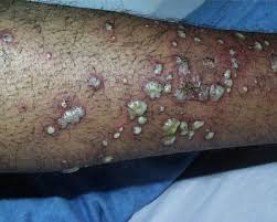 Staph  Infection  - Staph
