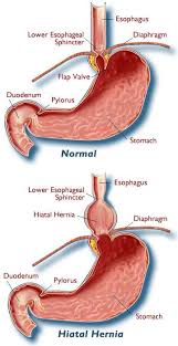 AcidRefluxHelp org  Acid Reflux   Home