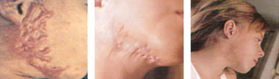 http://n.b5z.net/i/u/6141140/i//Keloid.jpg