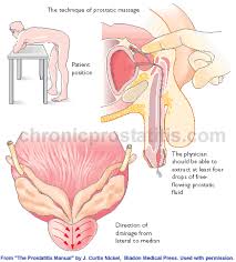 Prostatitis Prostate Massage
