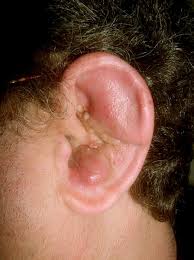 File:Auricular  perichondritis .