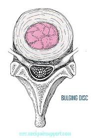 Bulging  Disc - Pretend you are