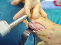 bunion surgery can be both