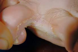 http://fromyourdoctor.com/ext/fungal_toe_infection.jpg