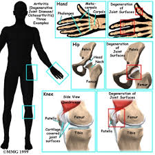  Arthritis 