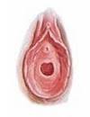 called “complacent” hymen,