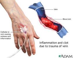 Superficial thrombophlebitis - via Daymix