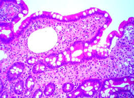Whipple S Disease