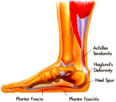  Foot Pain 