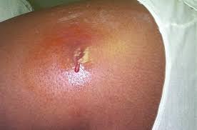 MRSA Picture / Staph Infection - via Daymix