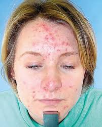 Fight  Acne  with Vitamins and