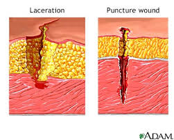 A  puncture wound 