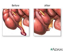from a simple  appendectomy 