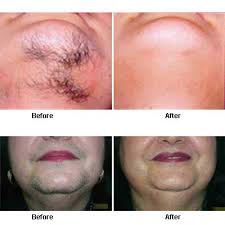 Laser hair removal was made