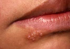 7 Recurrent  herpes simplex 