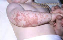 http://www.esculape.com/dermatologie/zz_dermatoses_virales_fichiers/30.jpg