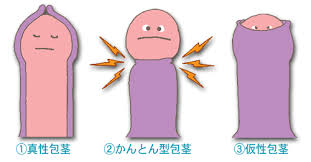 包茎の種類【新宿形成外科】