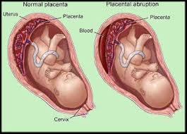 http://www.moondragon.org/obgyn/graphics/placentaabruptioncompare.jpg
