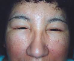 http://208.96.47.3/images/community/dermatlas/Angioneurotic_edema_1_071126.png
