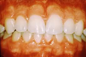  Gingivitis 