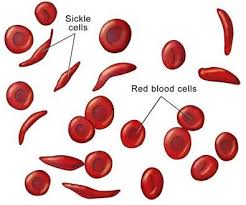 This type of  anemia  cannot be