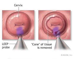  cervical dysplasia ,