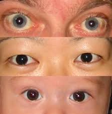 clearly operational eyes