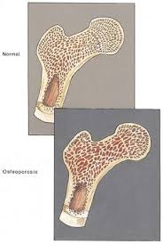  bone pain  or  tenderness 