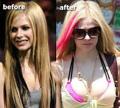 Avril Lavigne's Boob Job