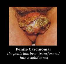  Cancer  of the  penis  presents