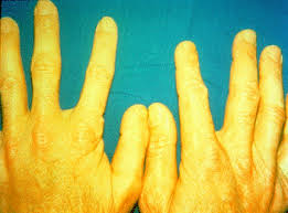 http://www.cdc.gov/niosh/topics/skin/images/derm086.gif