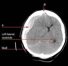  focal neurological deficit 