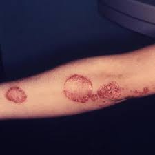  Psoriasis  Information