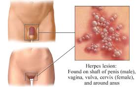  Herpes simplex  virus type 2