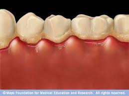  Gingivitis  and