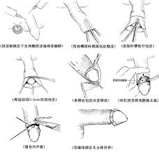 了解更多“包皮包茎术后保健”的