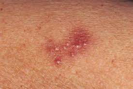  herpes _ simplex .jpg