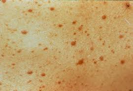 Hiv-rash | Chennai Outfits