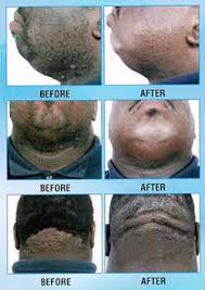 Ingrown Hair Problems In