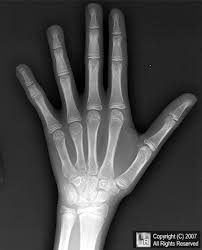 Short 4th metacarpal in Turner 