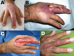 http://upload.wikimedia.org/wikipedia/commons/f/f3/Buruli_ulcer_hand_Peru.gif