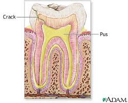 Tooth  Abscess  Image