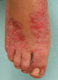  Acrodermatitis  enteropathica