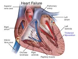 Heart Failure  Treatment Center