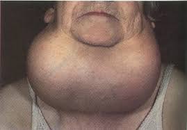 goiter