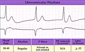 http://library.med.utah.edu/kw/ecg/mml/ecg_ideo.gif