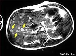 This upper  abdominal MRI scan 