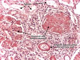 http://www.pathologyatlas.ro/pathology_atlas_imagini/amyloidosis_kidney_01.jpg
