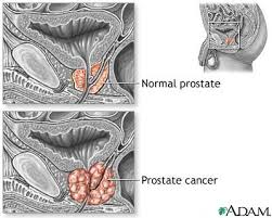  Prostate cancer 