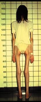 anorexic.jpg